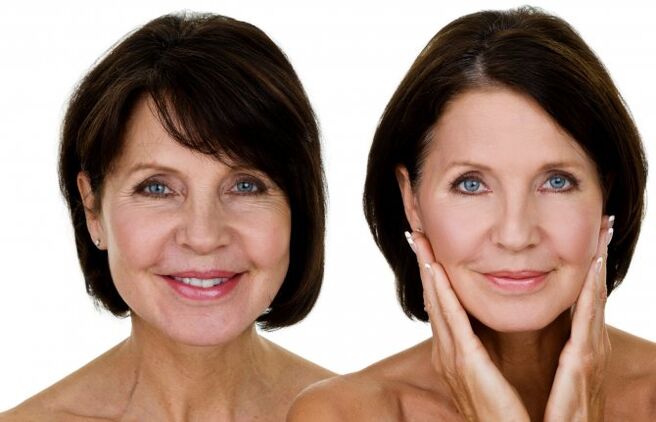 Before and after lifting RF