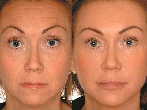 Before and after microcorry therapy