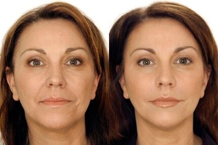 LPG face massage before and after