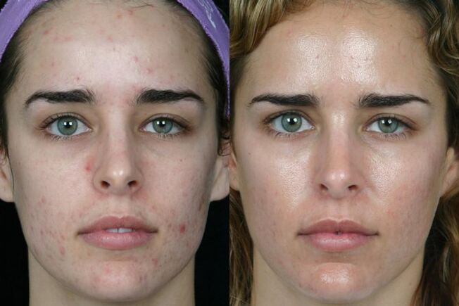 Laser grinding the skin of the face before and after